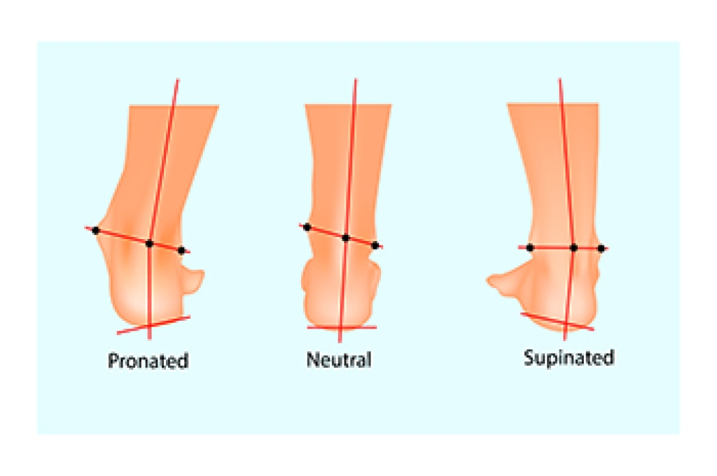 How Over-Pronation Can Affect Foot Health