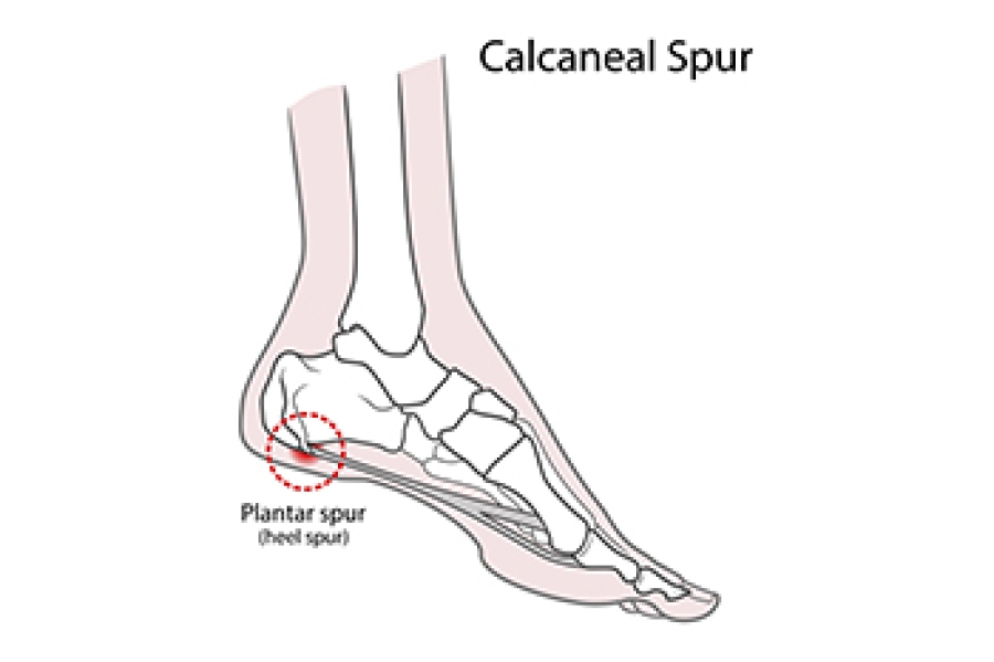 Calcaneal Spur Treatment For Plantar Fasciitis Heel Pain Calcaneal